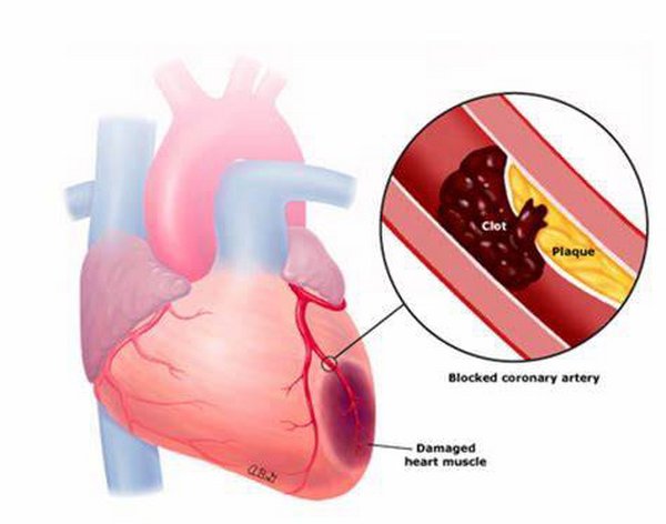 心梗家庭急救法